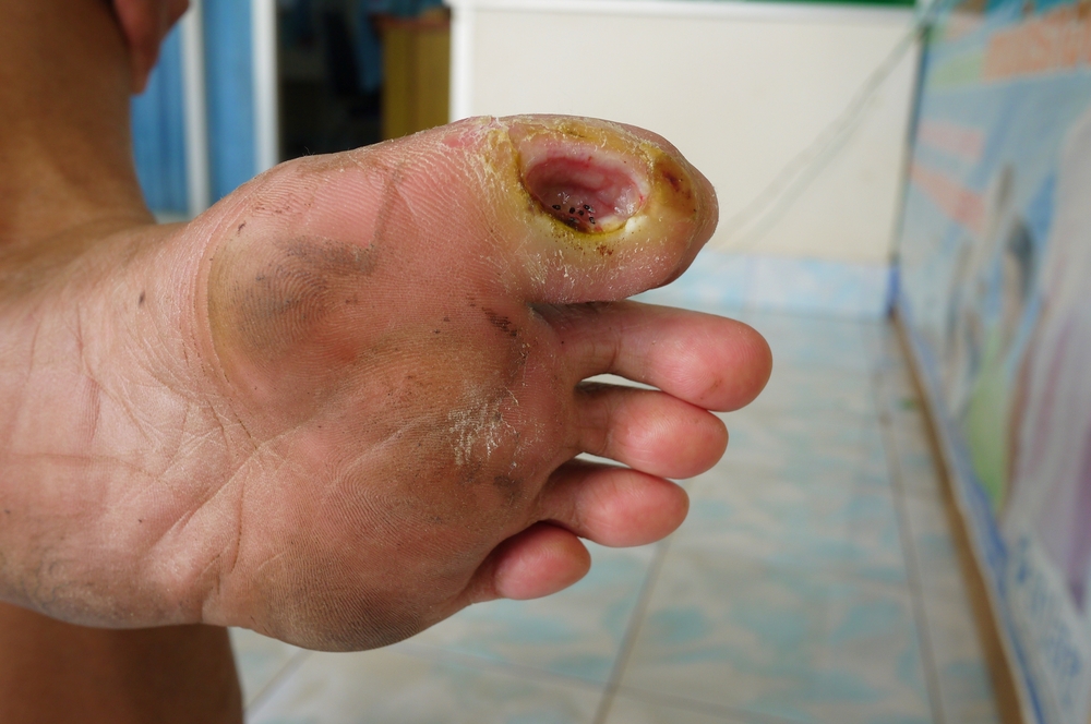 Diabetic Neuropathy- Treatment Modalities