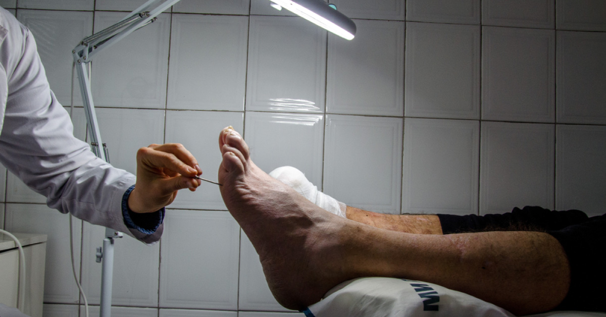 Diabetic Foot- Controlling Diabetes Is Paramount