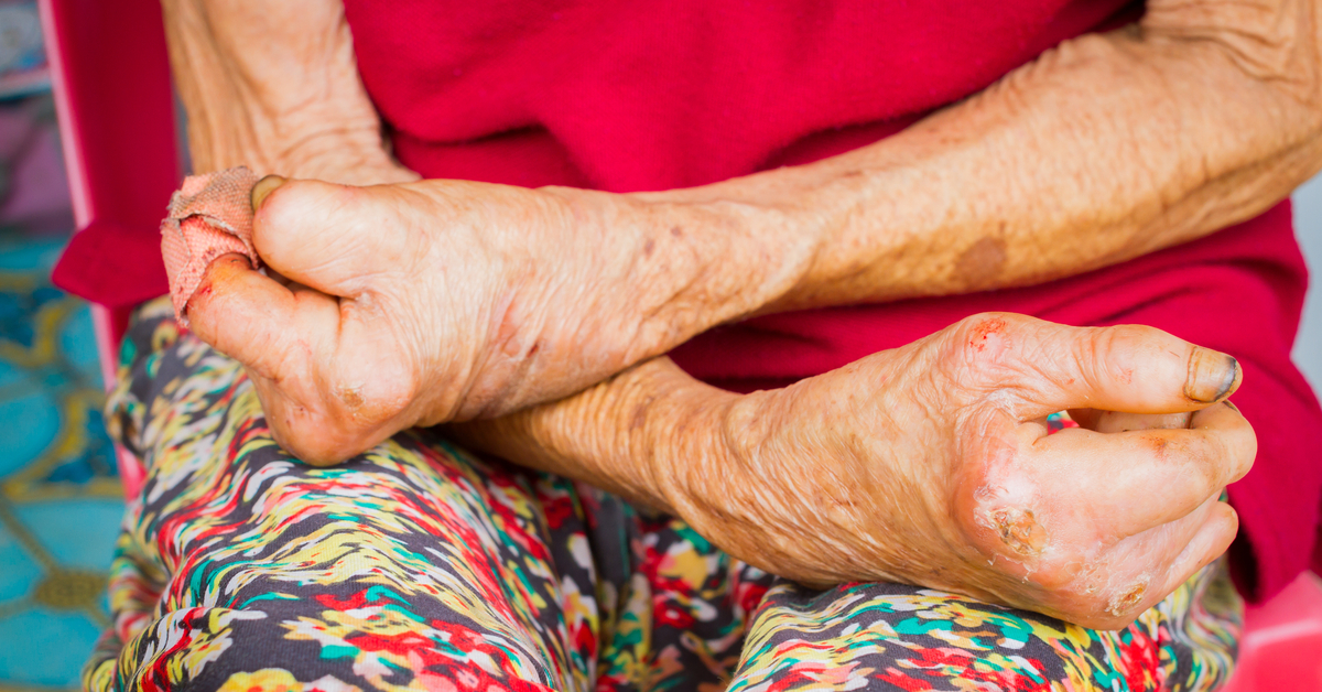Beyond The Myths: Life After Leprosy