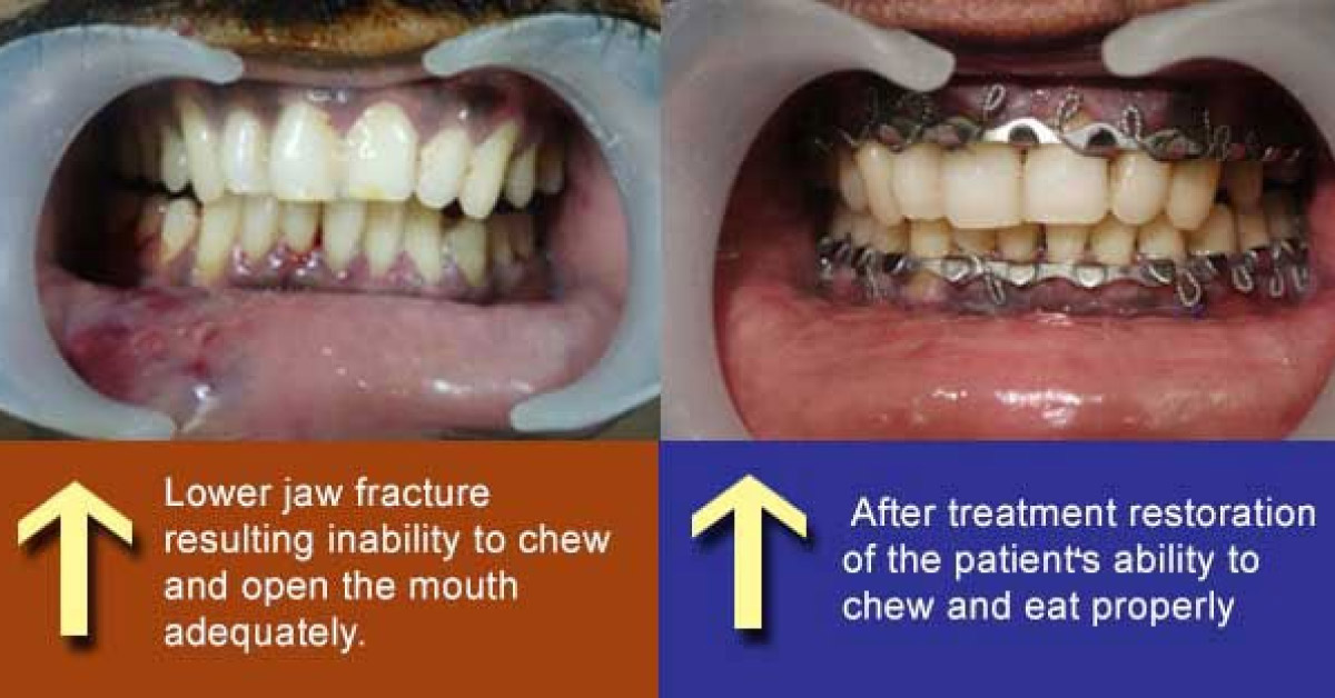 Treatment Of Mandibular Fractures