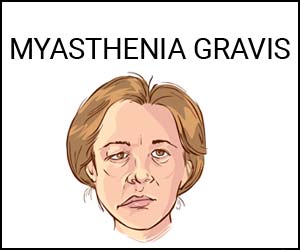 Zilucoplan– A Promising Treatment For Myasthenia Gravis