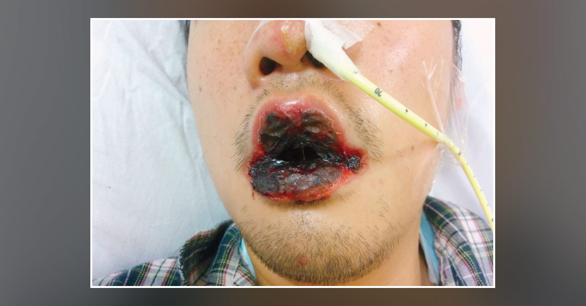A Young Man with Severe Mucositis