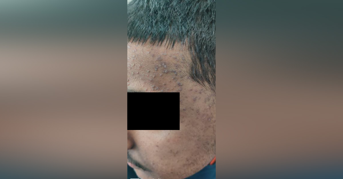 Diagnosis This Skin Condition