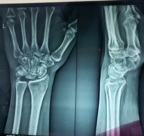 What Are These Lytic Areas In Wrist Bones?