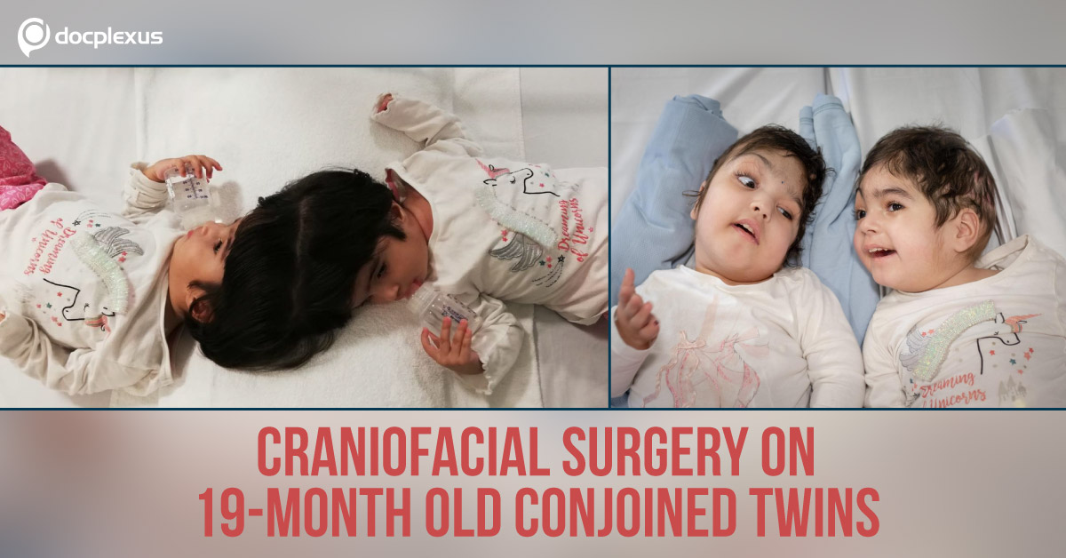 Craniopagus Conjoined Twins Survive Through Three Major Surgeries