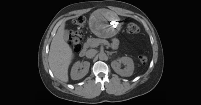 Abnormal Abdominal CT Scan