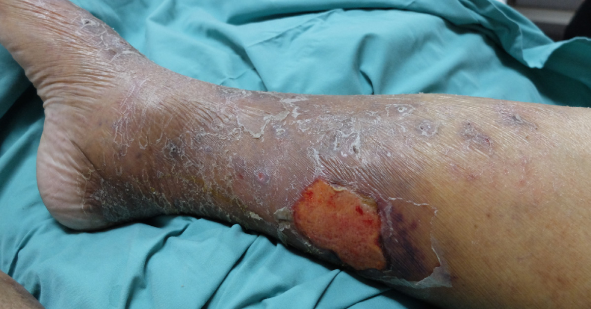 Interventional Methods For Peripheral Vascular Diseases In Diabetes