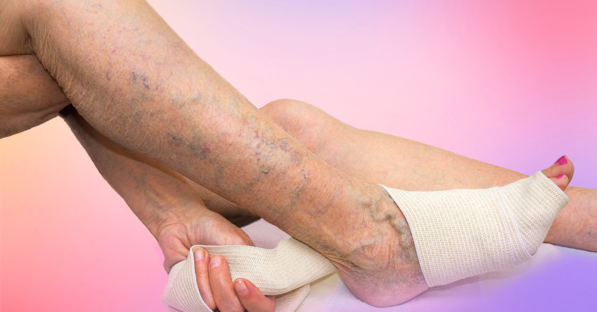 Peripheral Vascular Diseases In Diabetes And Calcification