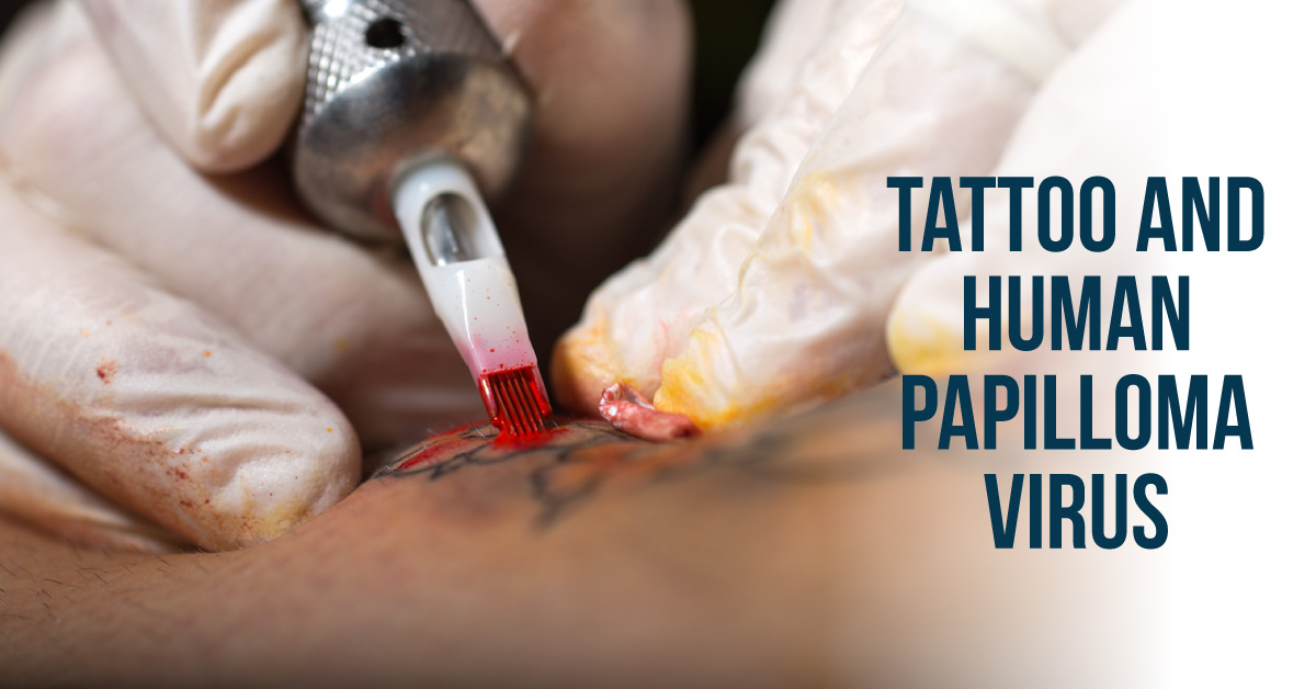 A Case of Tattoo-associated Flat Warts