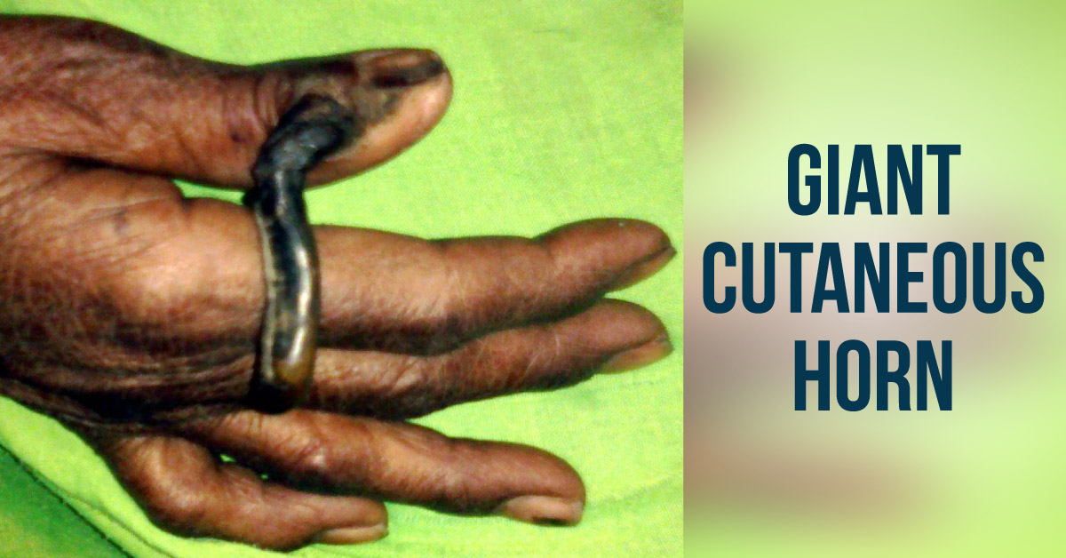 Keratotic Horn on the Thumb