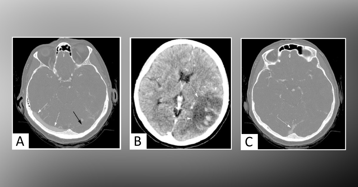 A Rare Case of Anemia with CVT