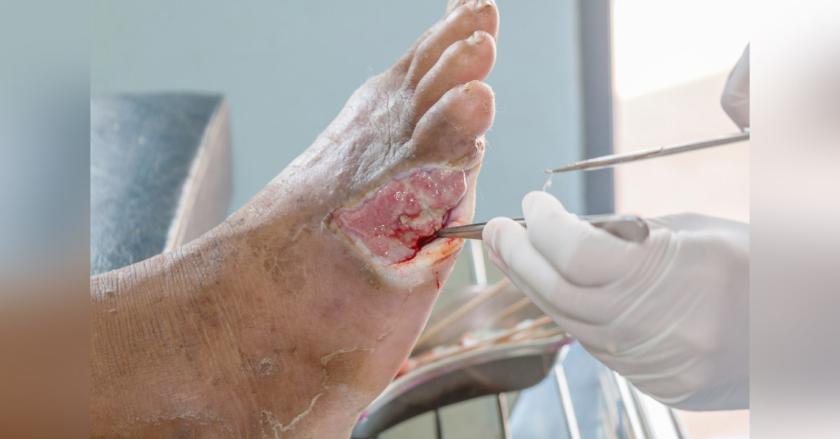 Diabetic Foot And Infections