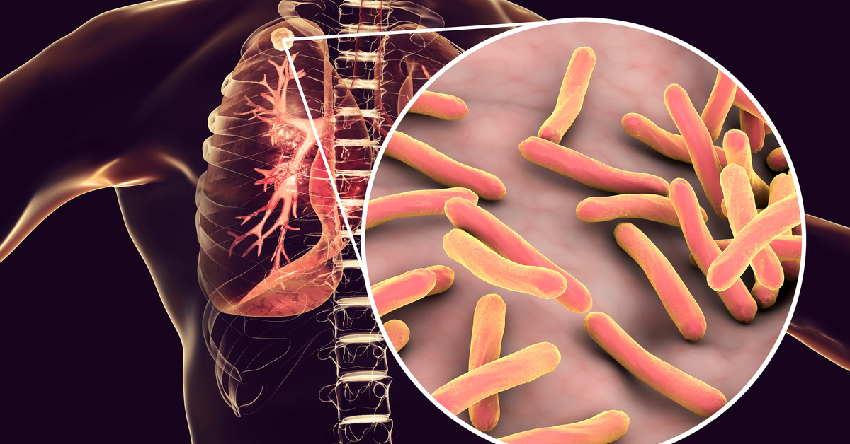 'Worryingly High’ Number Of People Infected With Latent Form Of Drug Resistant Tb