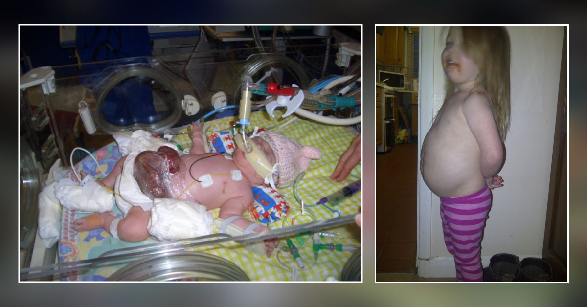 An Unusual Cause of Severe Malnutrition in a 3-year-old Girl with Gastroschisis
