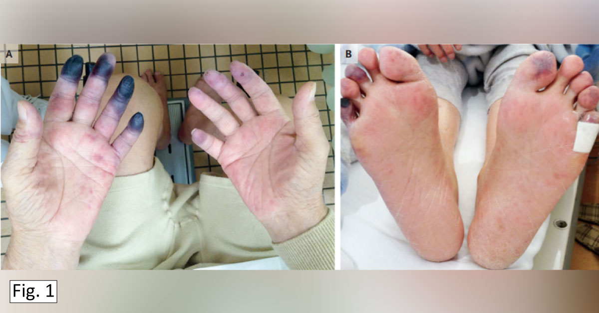 A Man With Blue-Black Discoloration On Fingers