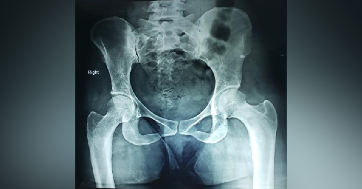Is There Any Pathology In Both SI Joints ?