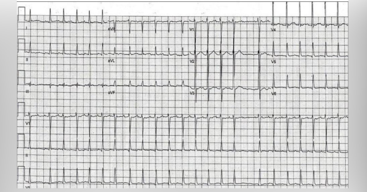 Case of a Patient with a Pounding Heart