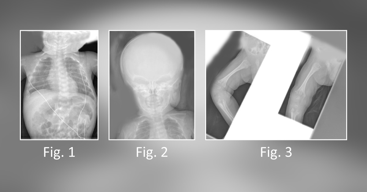 An Infant with Difficulty to Thrive and Hypercalcemia