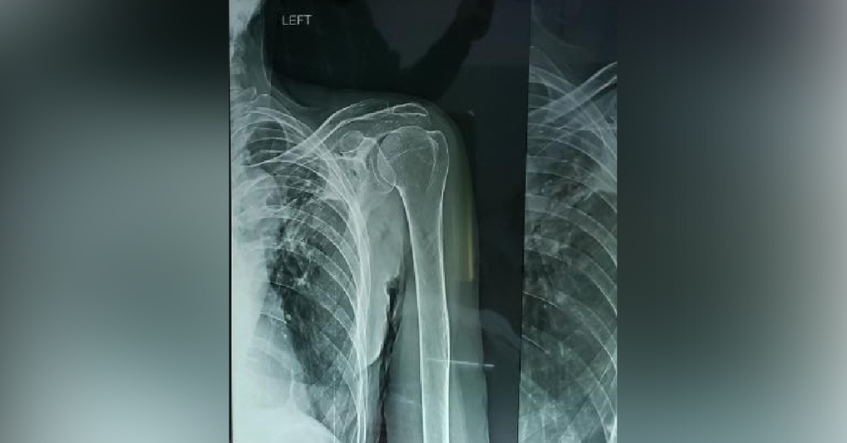 Where Is The Scapula Bone?