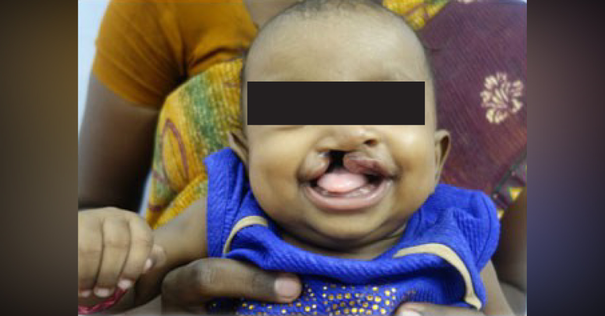 Cleft Lip And Palate Surgery