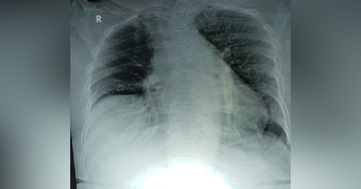 Can Recurrent Speticemia And UTI Be The Reported Problems In A 75 Year Old Woman?
