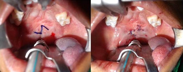 Furlow's Palatoplasty