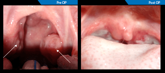 Case Of Tonsillitis