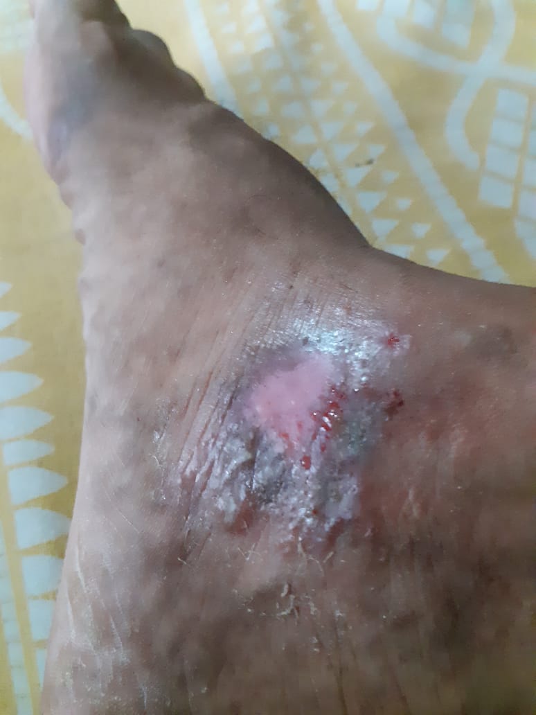 Itchy Papular Lesion Around Burn Scar