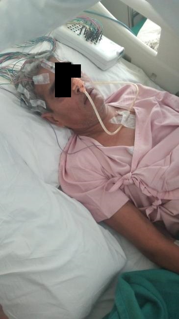 A Case Study Of Tuberculoma And CVA Responded Well In OPD Management