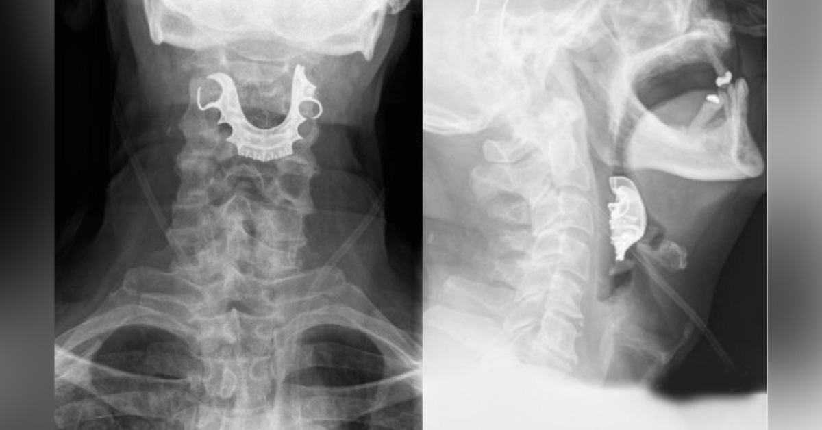 A Unique Case of Dentures Stuck in a Man’s Throat