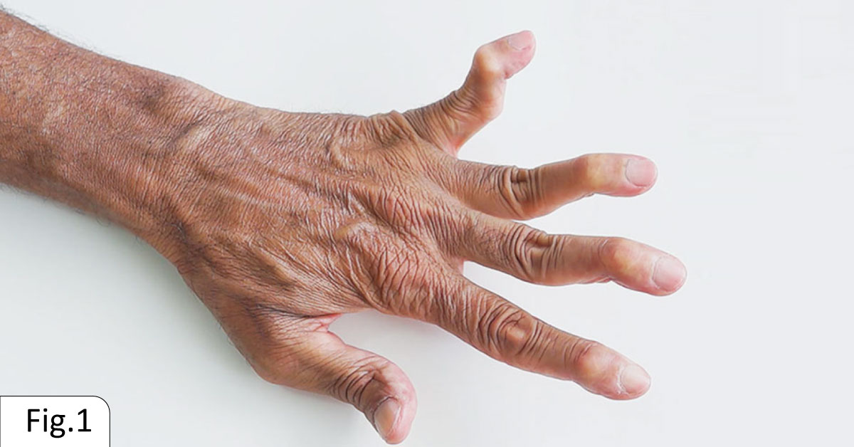 A Patient with Hand Deformities