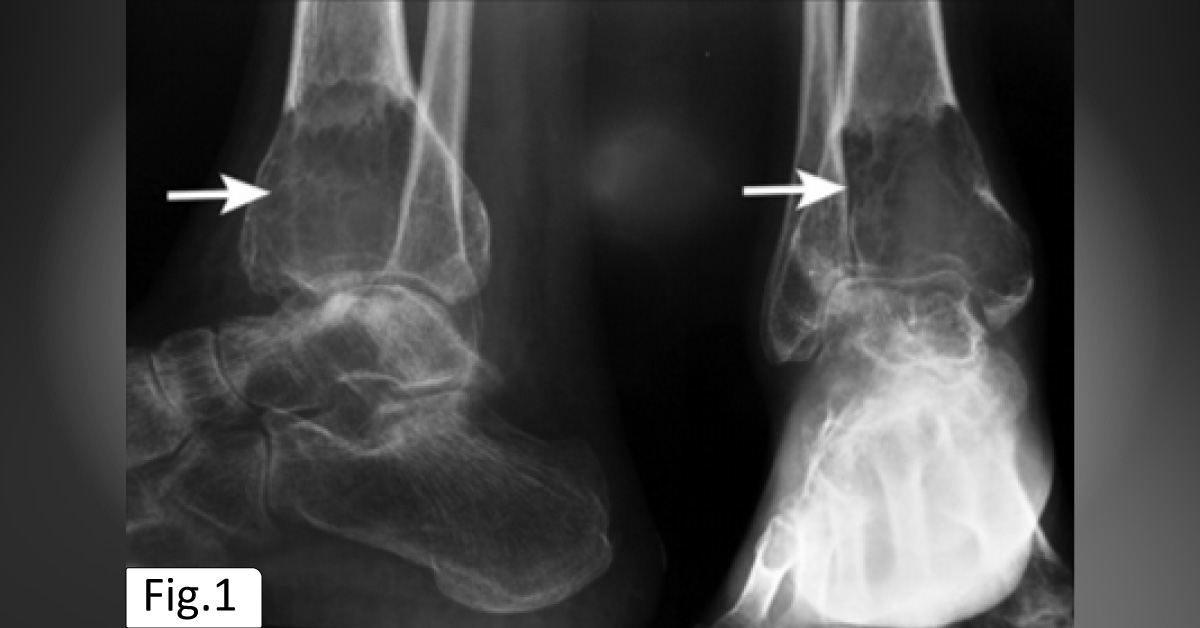 A Rare Case of a Distinct Tumor in a Bone