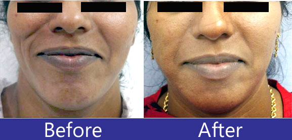 Fat Augmentation On The Face