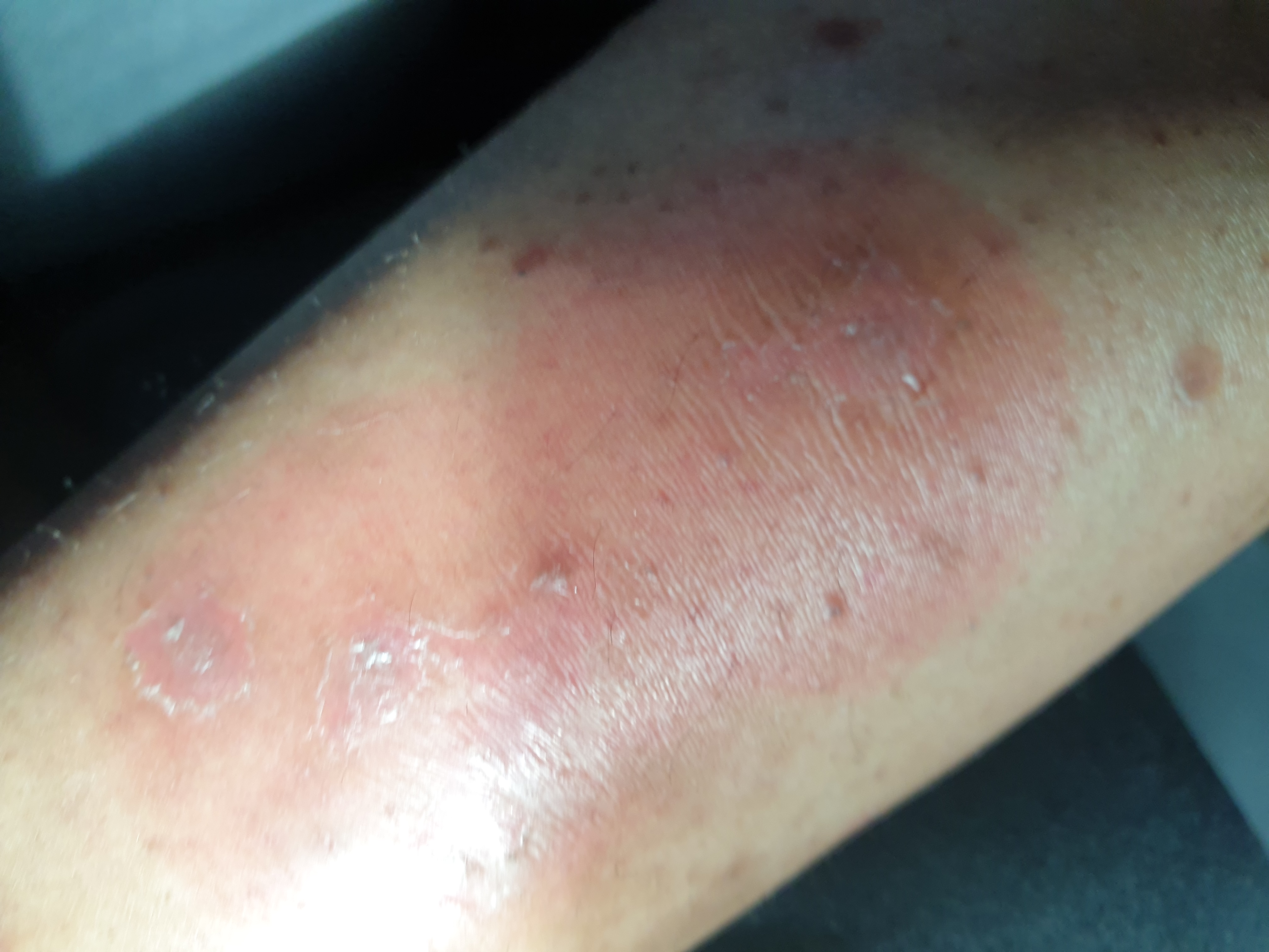Psoriasis Treatment