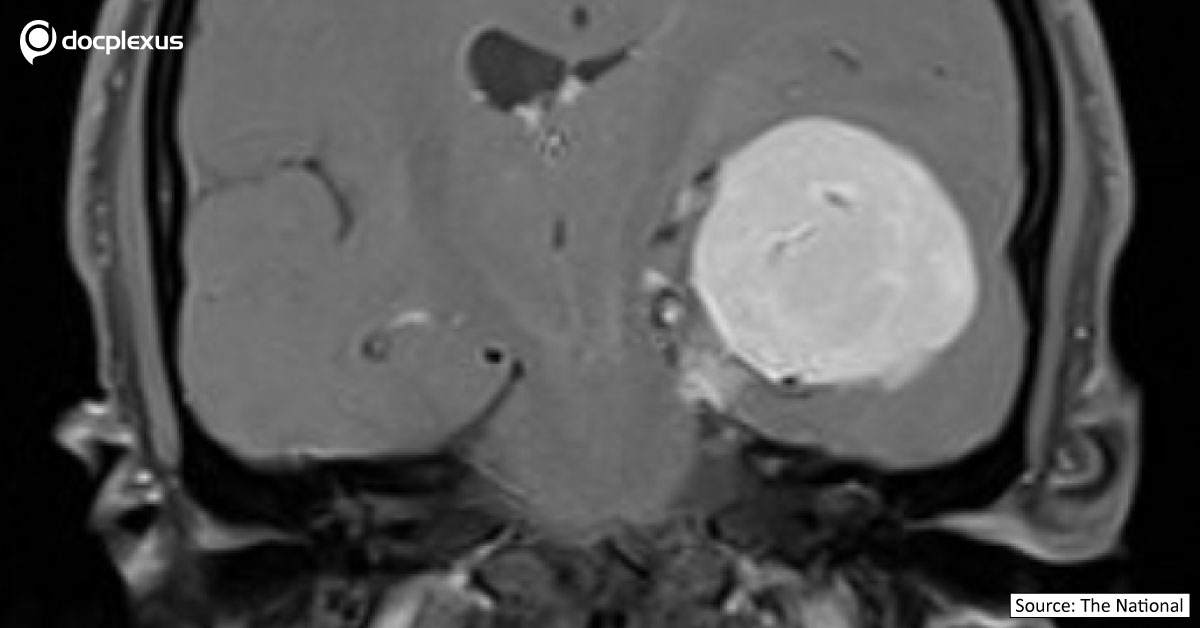UAE Surgeons Use Brain GPS To Remove A Giant Brain Tumor