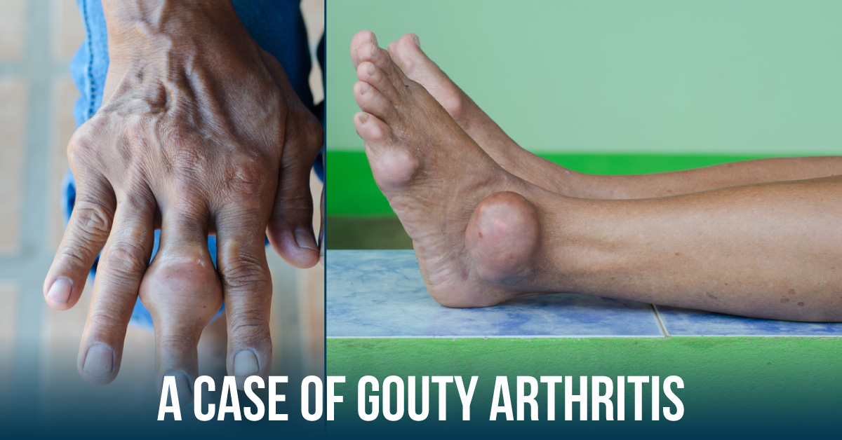 A Case of Juvenile Idiopathic Arthritis and Gout