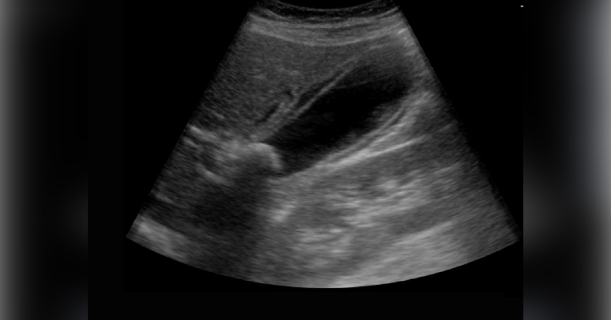 A Woman with Severe Pain in the Upper Quadrant of the Abdomen