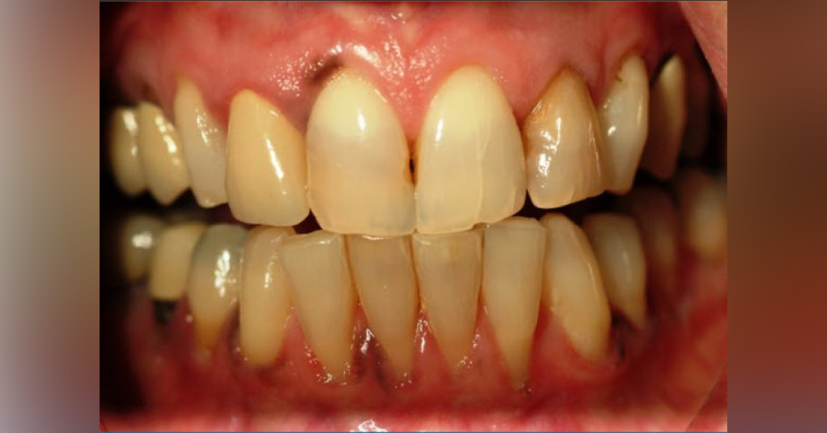 A Case of Unexplained Dental Discoloration