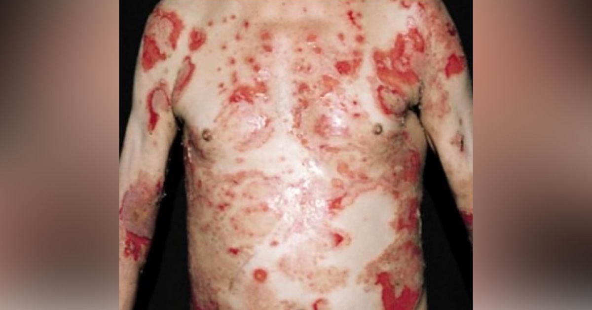 A Man With Widespread Painful Skin And Mucosal Erosion On The Body