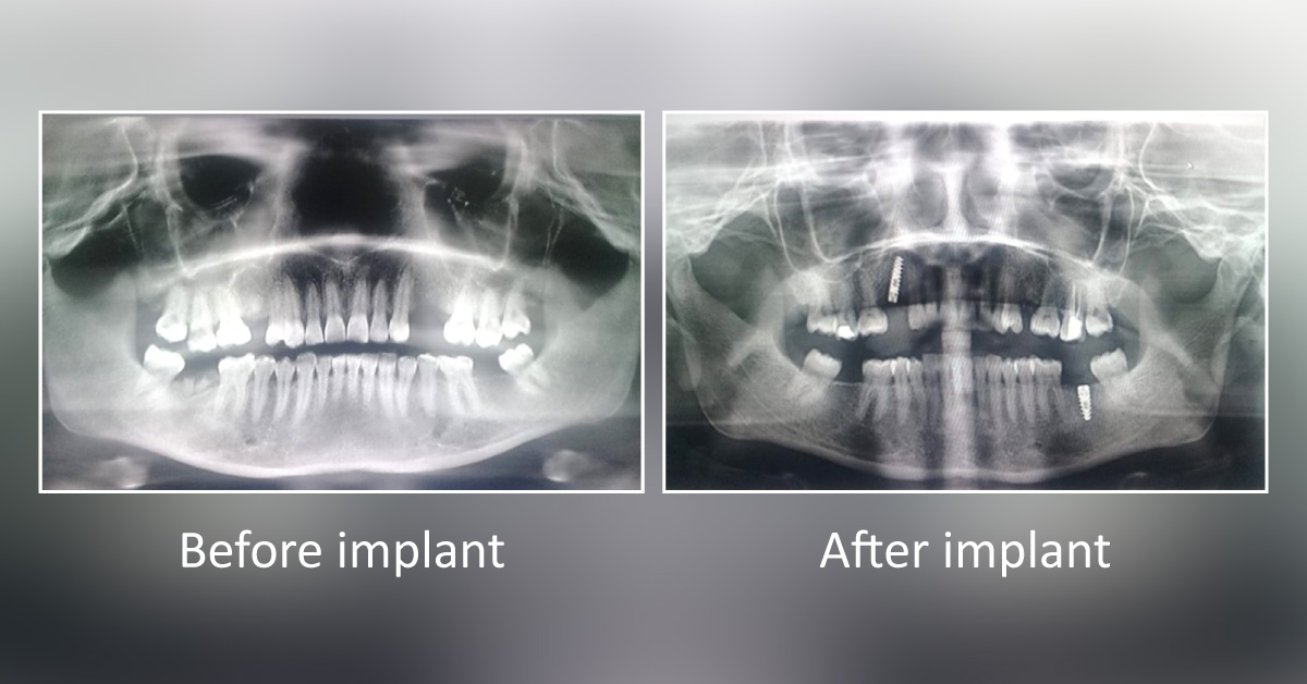 Extraction And Implant Placement On The Same Day