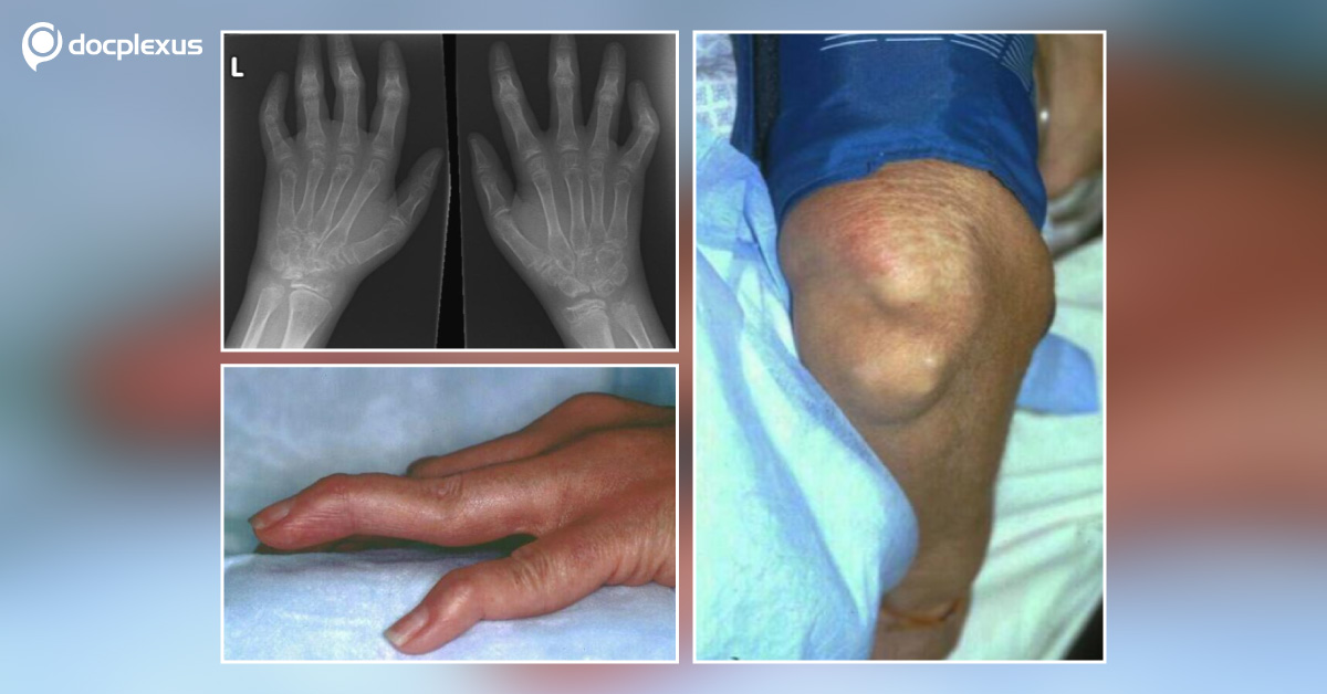 Clinical Aspects of Rheumatoid Arthritis