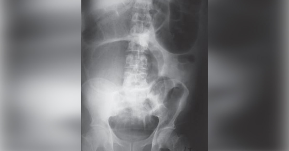 Case of Abdominal Swelling After Hip Replacement