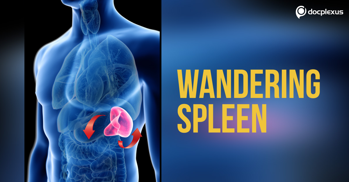 When the Spleen Wanders - A Case Study