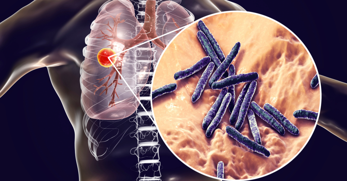 Tuberculosis: The Terrorist Who Kills 2 Lakh Indians Every Year