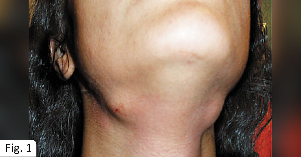 A Patient With An Unexplained Submandibular Pain
