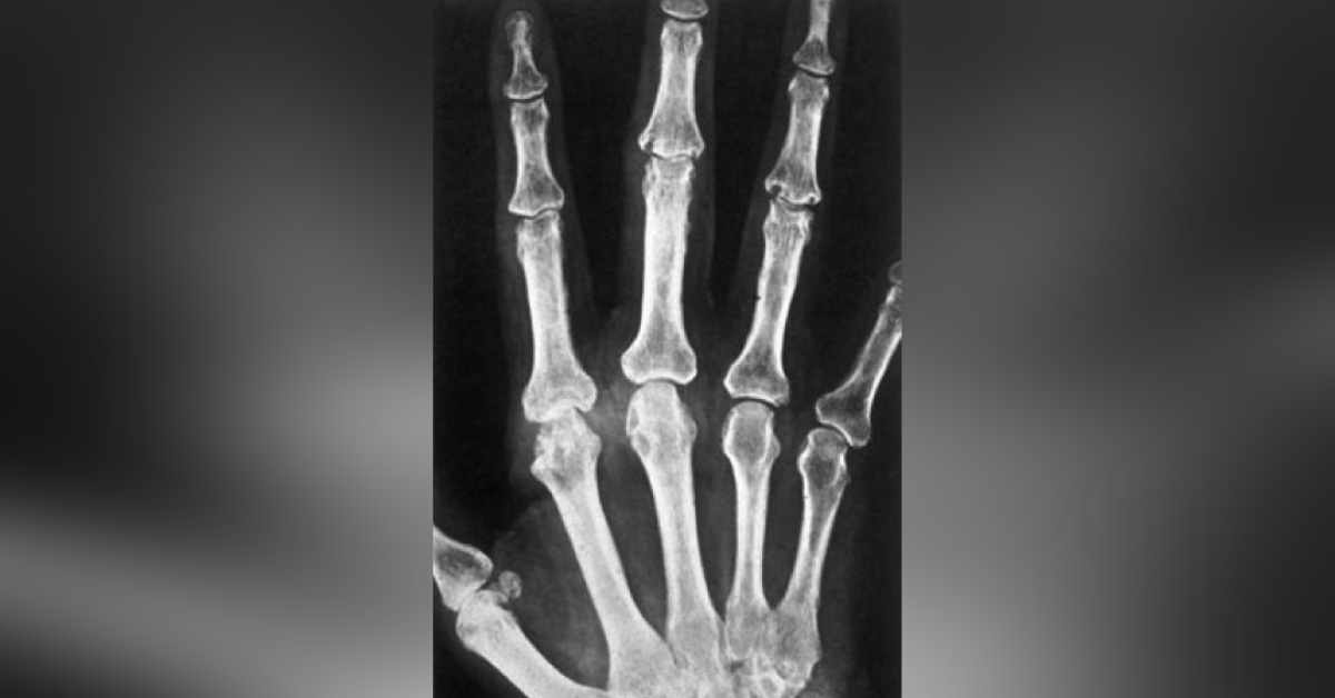 Case of Excruciating Pain in the Hands of a Young Woman
