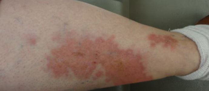 Case of a Woman with a Painless Red Rash