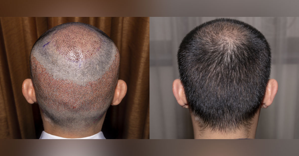 The Miracle For Balding Hair – Hair Transplant Surgery!
