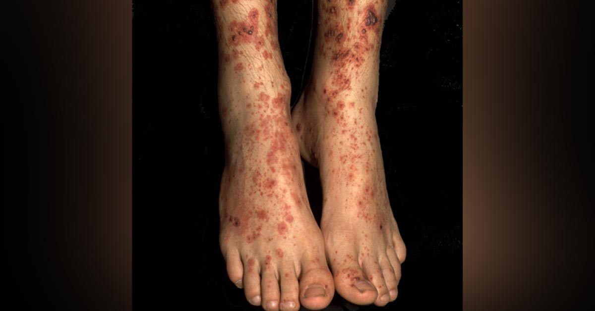 Pruritic Lesions on the Feet
