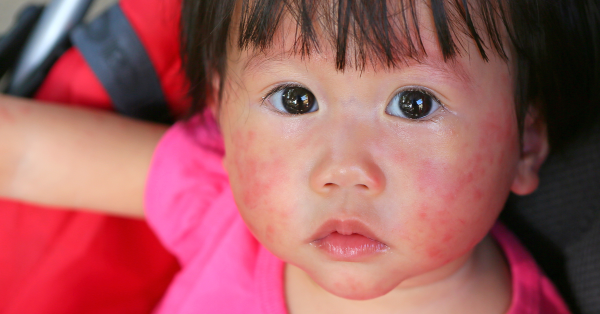 Parental And Child Factors Associated With Inhalant And Food Allergy